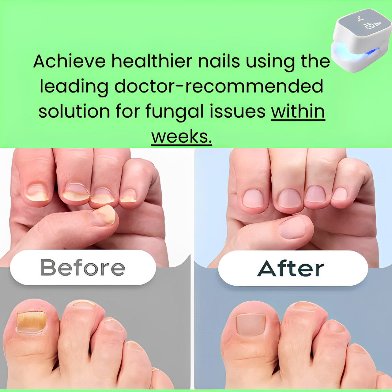 Rosamua ™ - Nail Fungus Laser Device