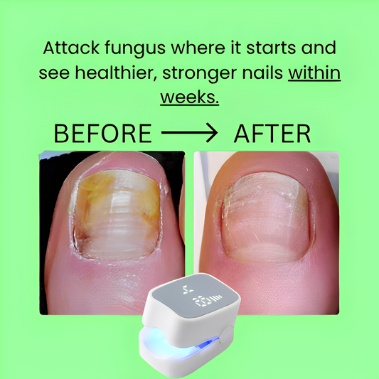 Rosamua ™ - Nail Fungus Laser Device